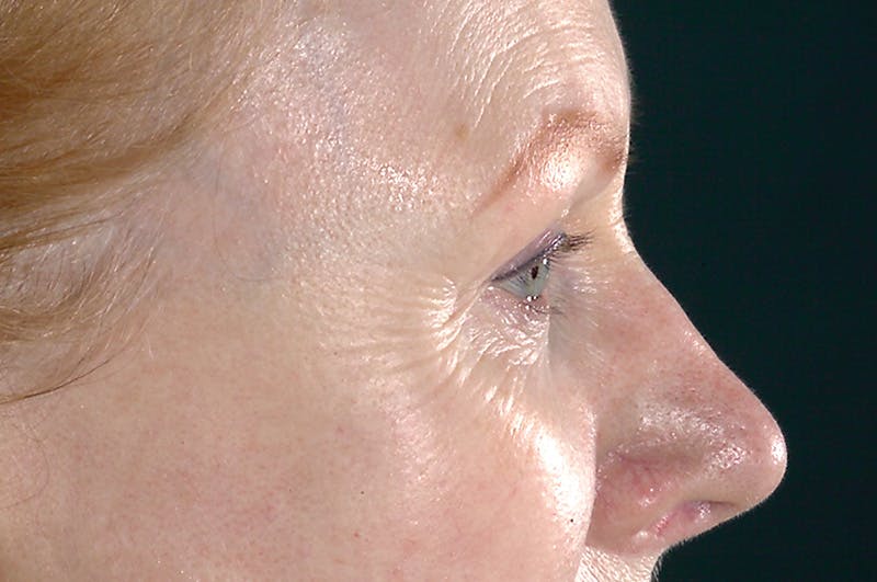 Eyelid Surgery Before & After Gallery - Patient 378862 - Image 3
