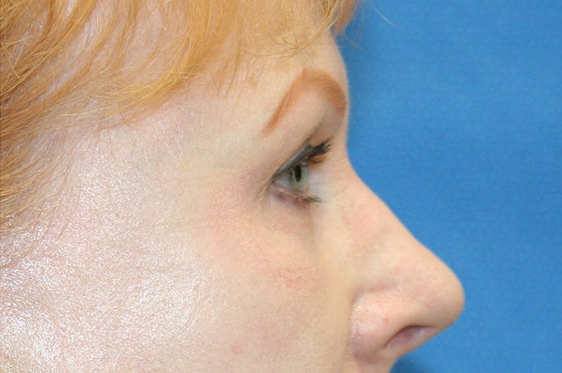 Eyelid Surgery Before & After Gallery - Patient 378862 - Image 4