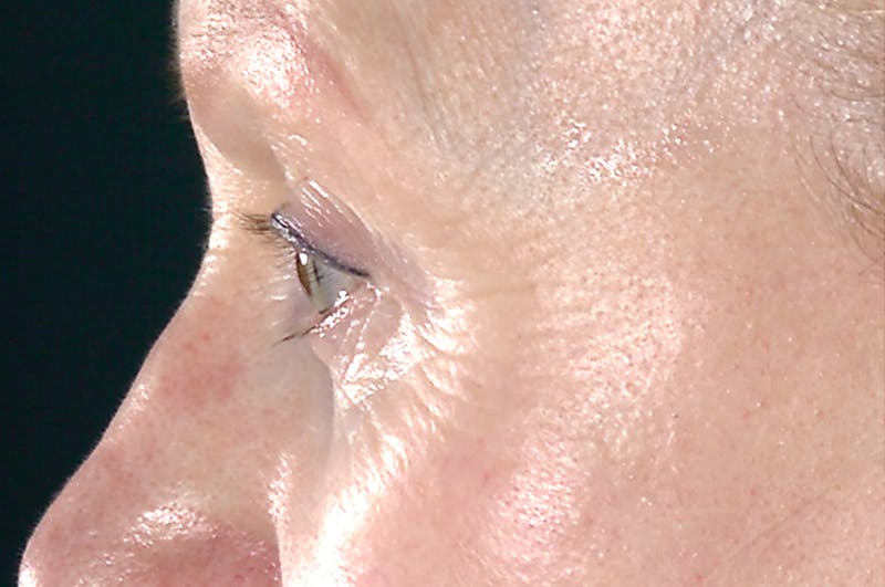 Eyelid Surgery Before & After Gallery - Patient 378862 - Image 5