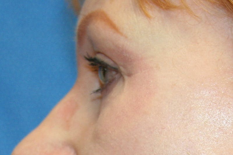 Eyelid Surgery Before & After Gallery - Patient 378862 - Image 6