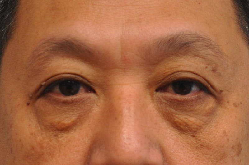 Eyelid Surgery Before & After Gallery - Patient 244826 - Image 1