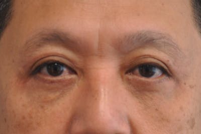 Eyelid Surgery Before & After Gallery - Patient 244826 - Image 2