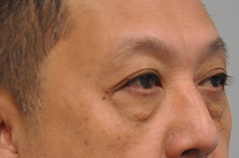 Eyelid Surgery Before & After Gallery - Patient 244826 - Image 3