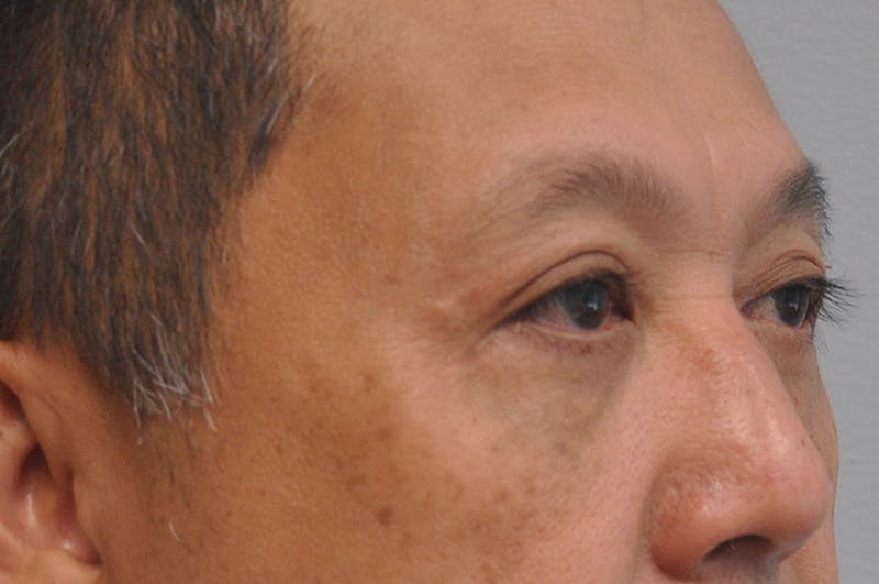 Eyelid Surgery Before & After Gallery - Patient 244826 - Image 4
