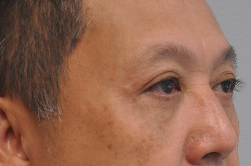 Eyelid Surgery Before & After Gallery - Patient 244826 - Image 4