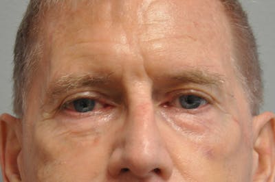Eyelid Surgery Before & After Gallery - Patient 117796 - Image 1