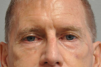 Eyelid Surgery Before & After Gallery - Patient 117796 - Image 1