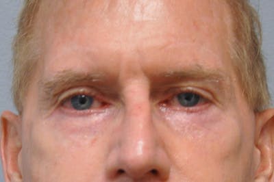 Eyelid Surgery Before & After Gallery - Patient 117796 - Image 2