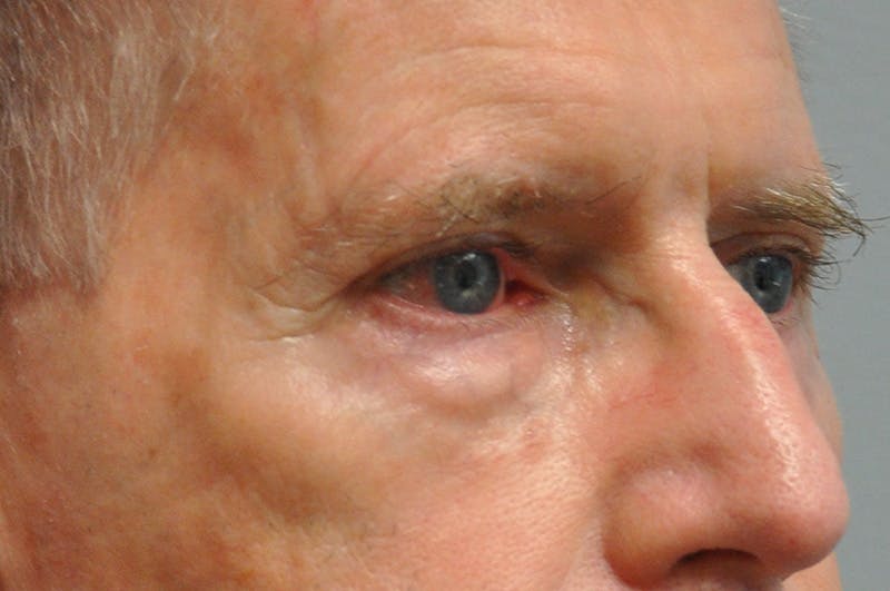 Eyelid Surgery Before & After Gallery - Patient 117796 - Image 3