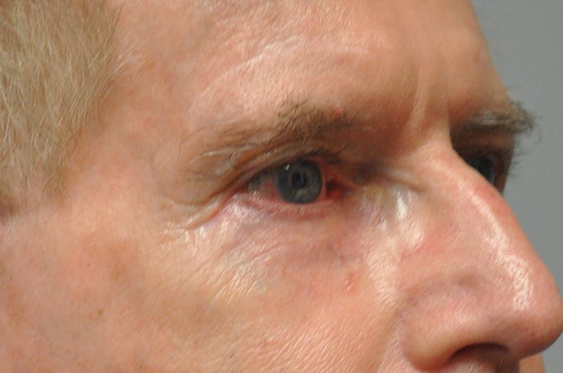 Eyelid Surgery Before & After Gallery - Patient 117796 - Image 4