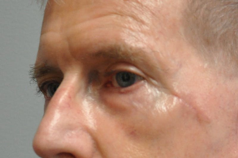 Eyelid Surgery Before & After Gallery - Patient 117796 - Image 5