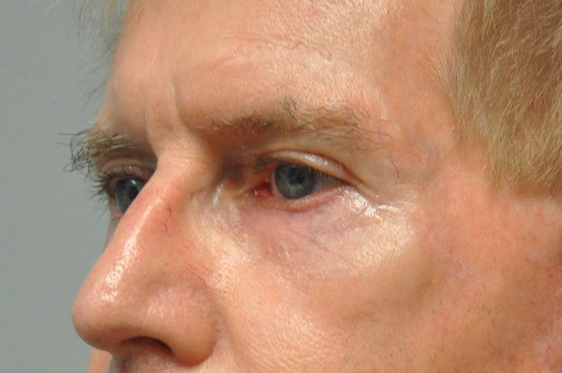 Eyelid Surgery Before & After Gallery - Patient 117796 - Image 6