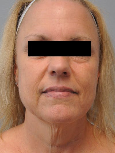 Facelift Before & After Gallery - Patient 186213 - Image 1