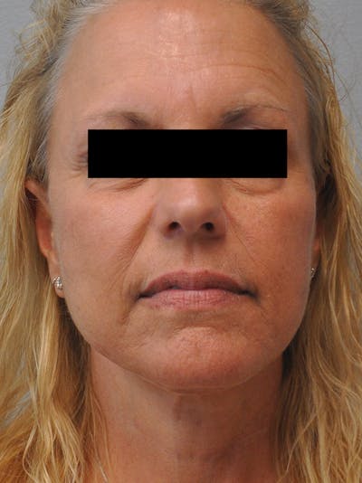 Facelift Before & After Gallery - Patient 186213 - Image 2