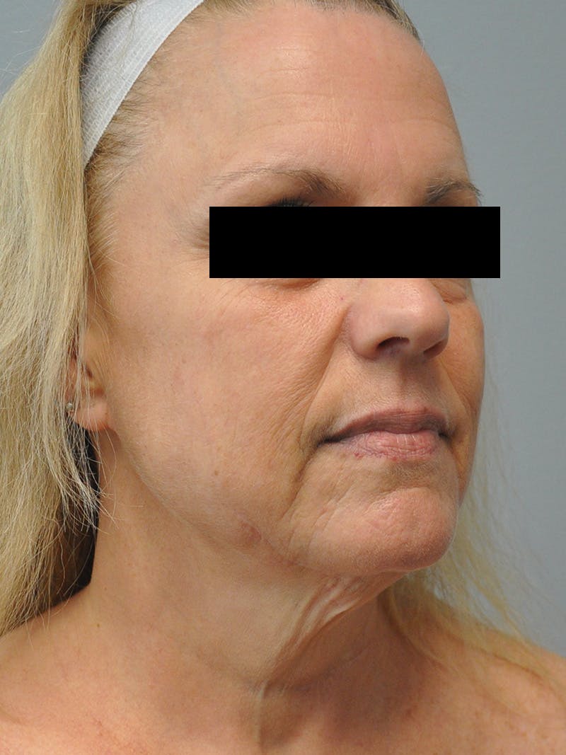 Facelift Before & After Gallery - Patient 186213 - Image 3