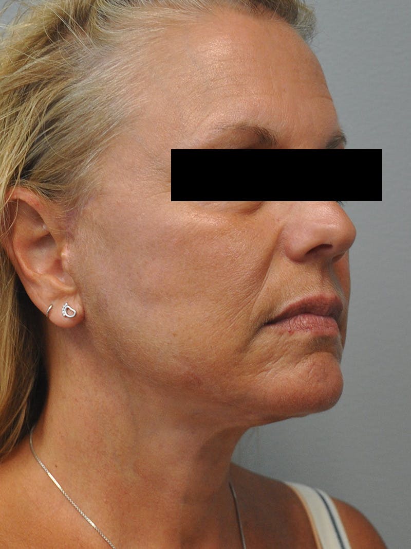 Facelift Before & After Gallery - Patient 186213 - Image 4