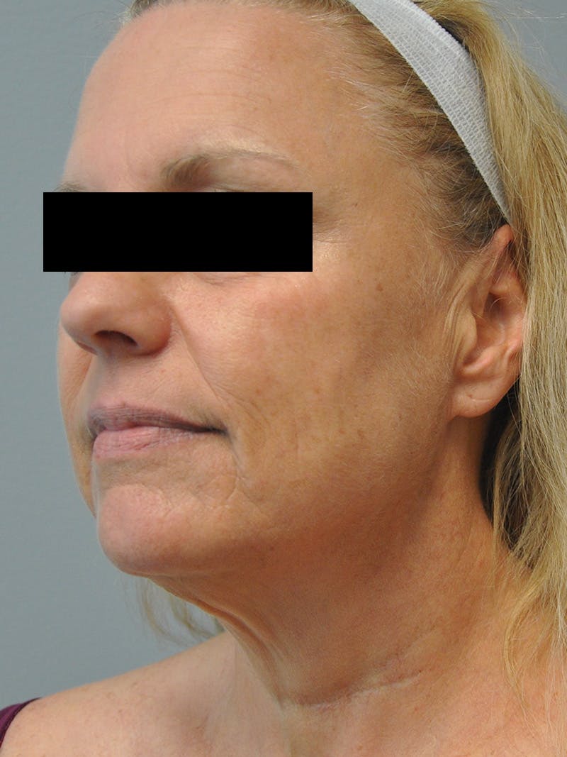 Facelift Before & After Gallery - Patient 186213 - Image 5