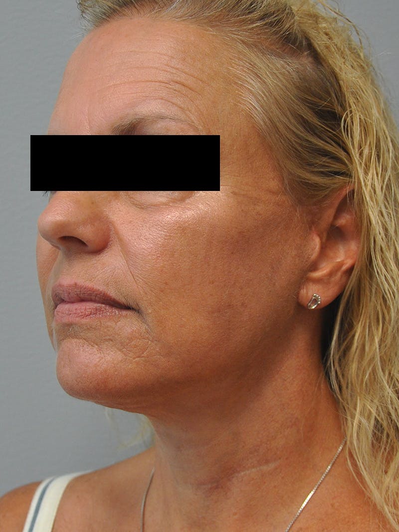 Facelift Before & After Gallery - Patient 186213 - Image 6