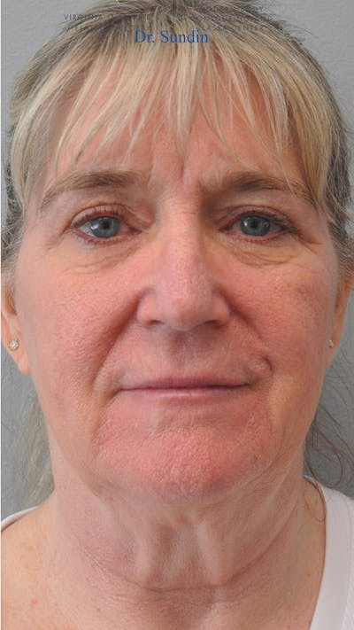 Facelift Before & After Gallery - Patient 305928 - Image 1