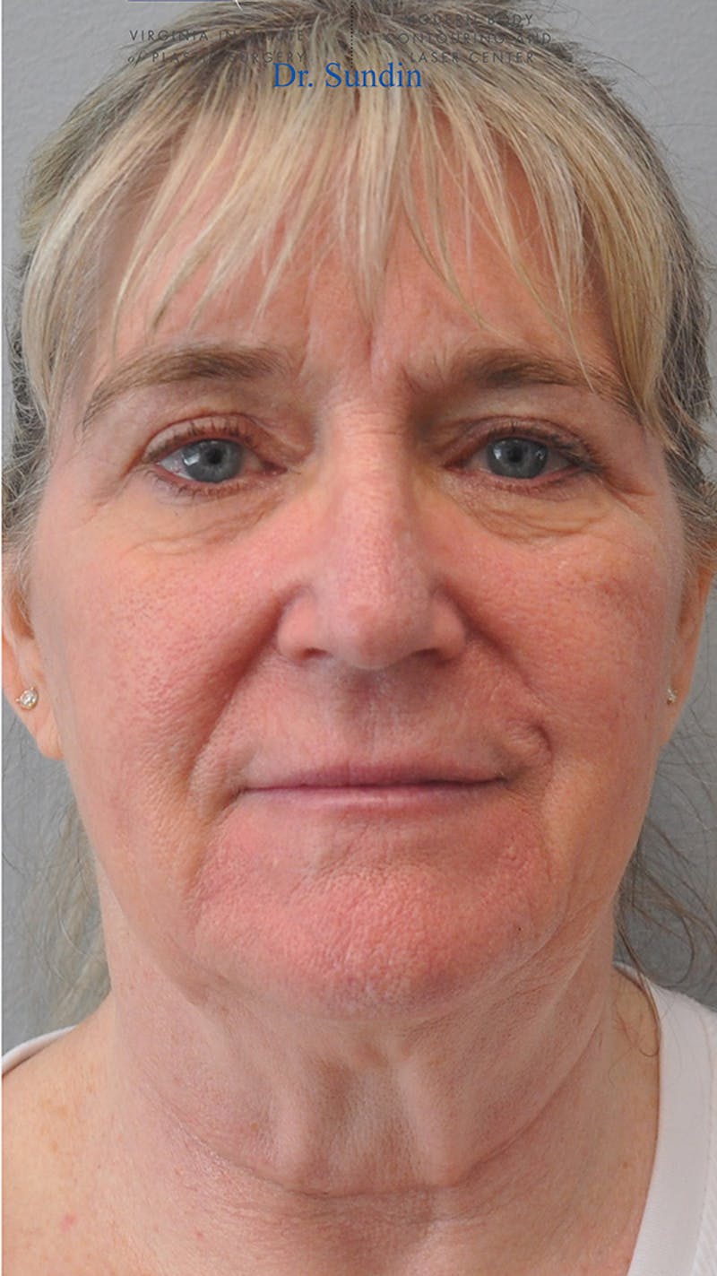Facelift Before & After Gallery - Patient 305928 - Image 1
