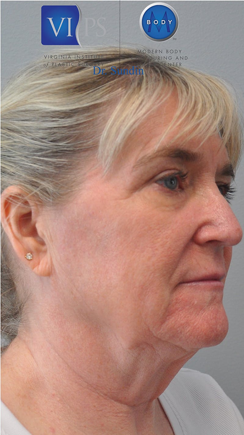 Facelift Before & After Gallery - Patient 305928 - Image 3