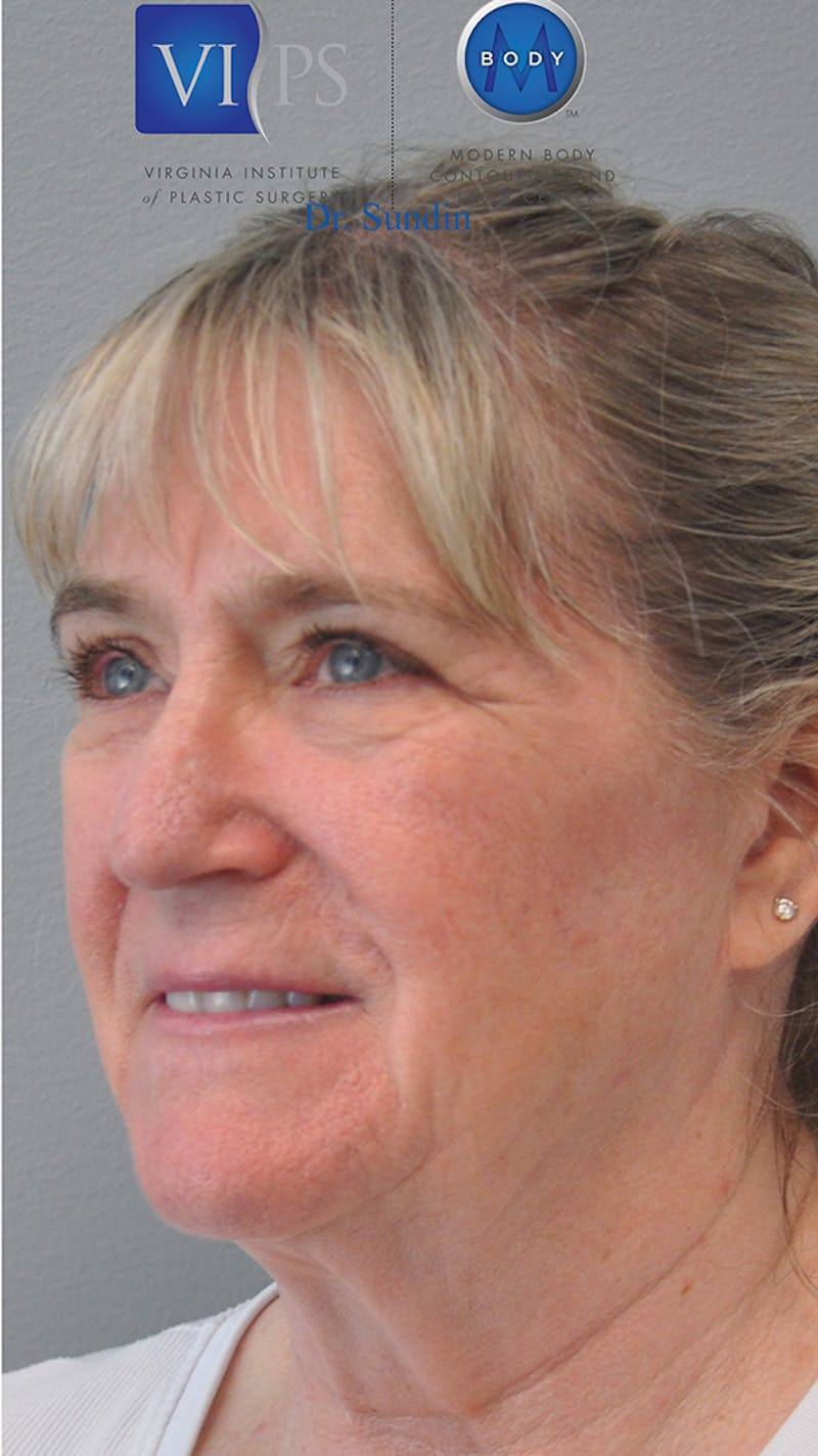 Facelift Before & After Gallery - Patient 305928 - Image 5