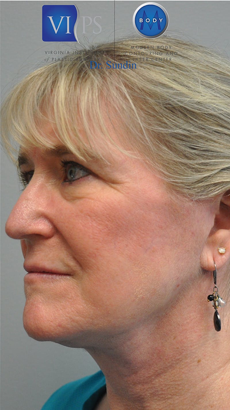 Facelift Before & After Gallery - Patient 305928 - Image 6