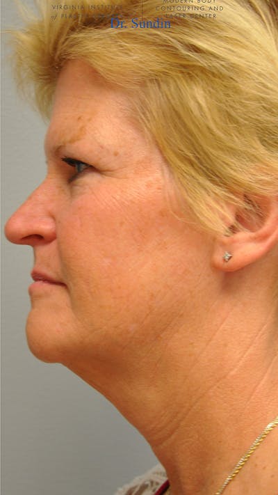 Facelift Before & After Gallery - Patient 287593 - Image 1