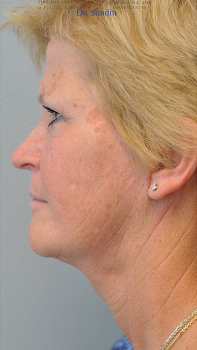 Facelift Before & After Gallery - Patient 287593 - Image 2