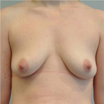 Breast Augmentation with Fat Grafting Before & After Gallery - Patient 518784 - Image 1