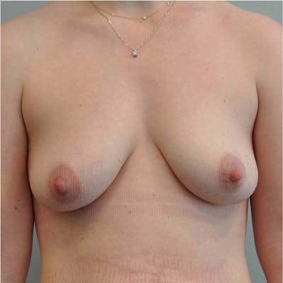 Breast Augmentation with Fat Grafting Before & After Gallery - Patient 518784 - Image 2