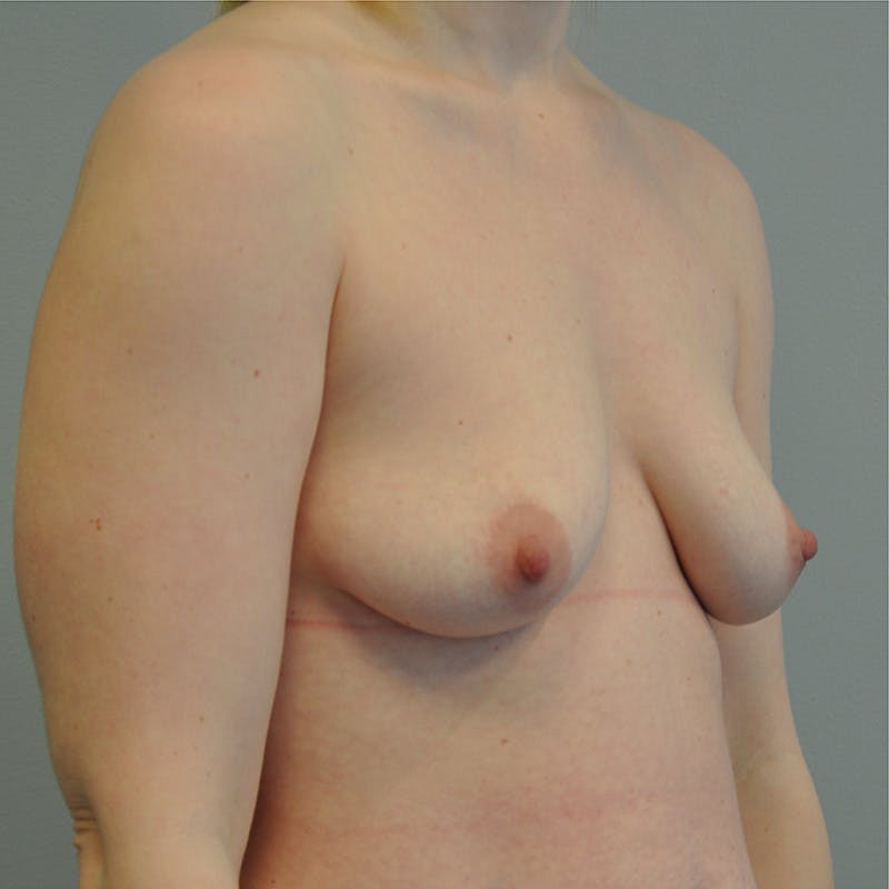 Breast Augmentation with Fat Grafting Before & After Gallery - Patient 518784 - Image 3
