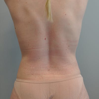 Liposuction Before & After Gallery - Patient 128141 - Image 2