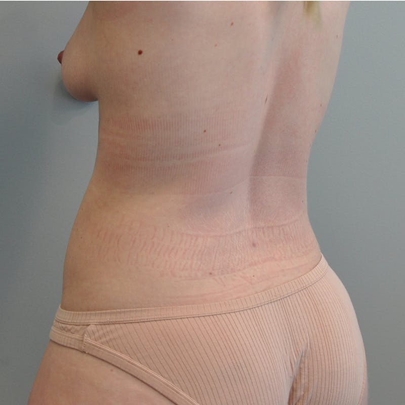 Liposuction Before & After Gallery - Patient 128141 - Image 4