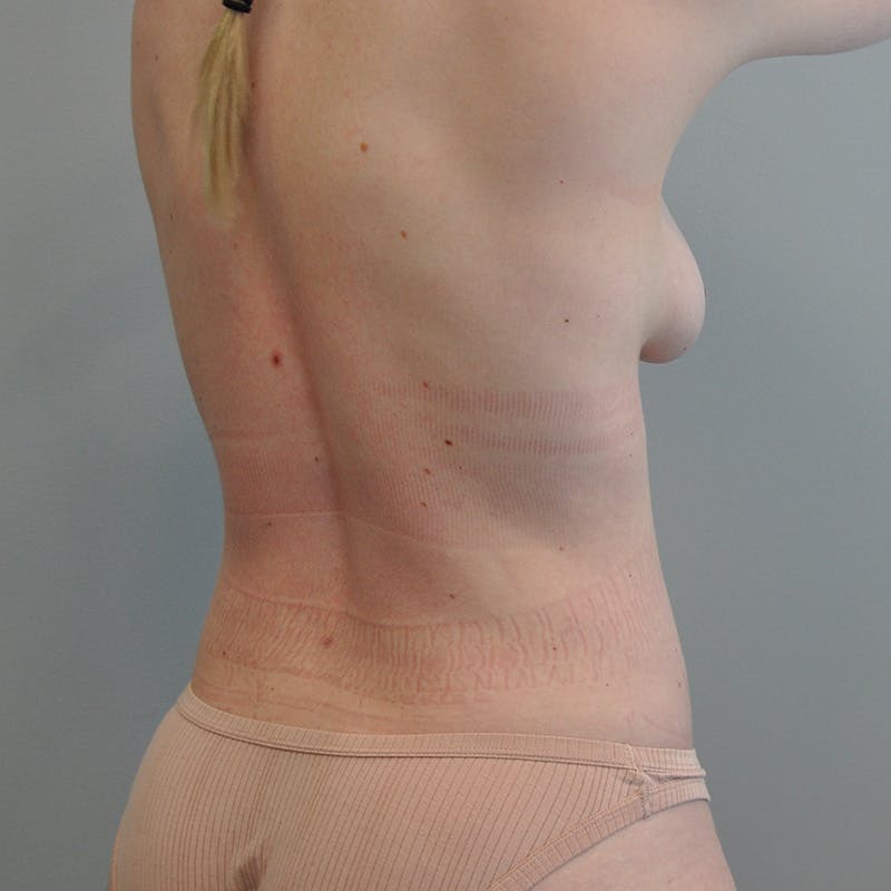 JPlasma Before & After Gallery - Patient 276154 - Image 6