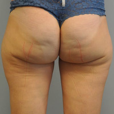 Liposuction Before & After Gallery - Patient 284945 - Image 1