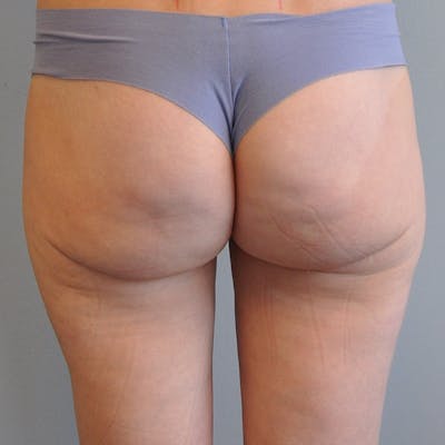 Liposuction Before & After Gallery - Patient 284945 - Image 2