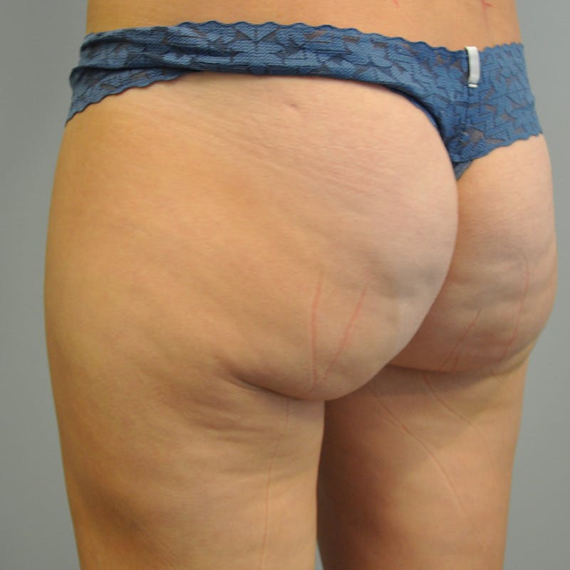 Liposuction Before & After Gallery - Patient 284945 - Image 3