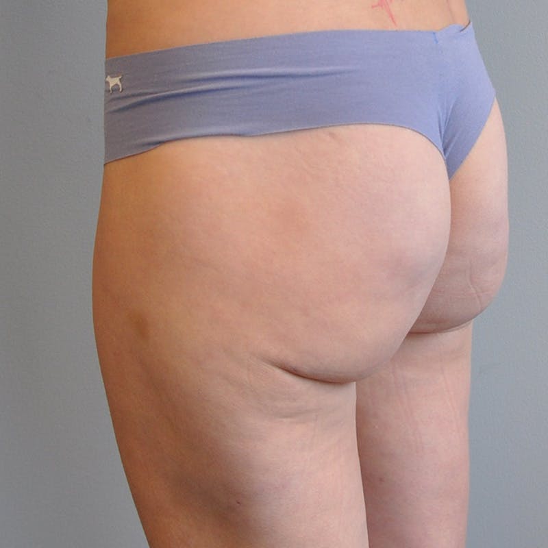 Liposuction Before & After Gallery - Patient 284945 - Image 4