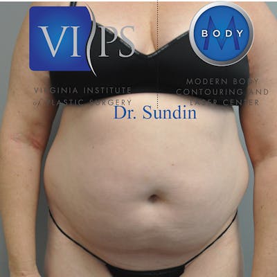 Liposuction Before & After Gallery - Patient 352267 - Image 1