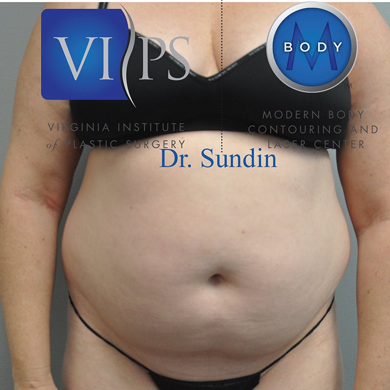 Liposuction Before & After Gallery - Patient 352267 - Image 1