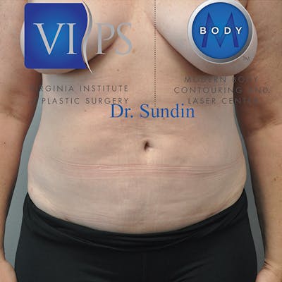 Liposuction Before & After Gallery - Patient 352267 - Image 2