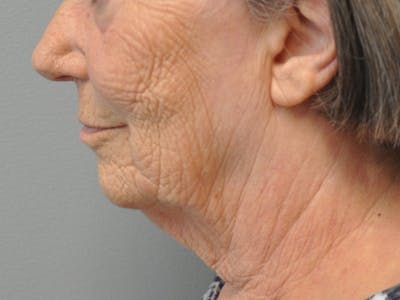 Neck Lift Before & After Gallery - Patient 798770 - Image 1