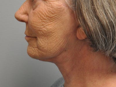 Neck Lift Before & After Gallery - Patient 798770 - Image 2