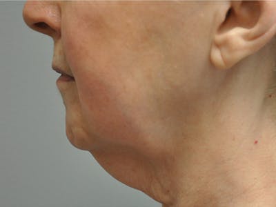 Neck Lift Before & After Gallery - Patient 137051 - Image 1