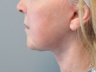 Neck Lift Before & After Gallery - Patient 137051 - Image 2