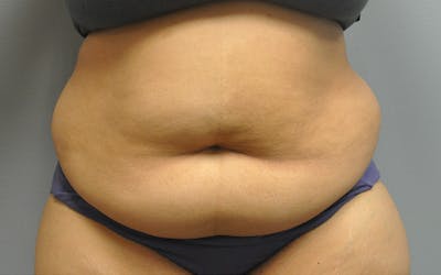 Tummy Tuck Before & After Gallery - Patient 158773 - Image 1