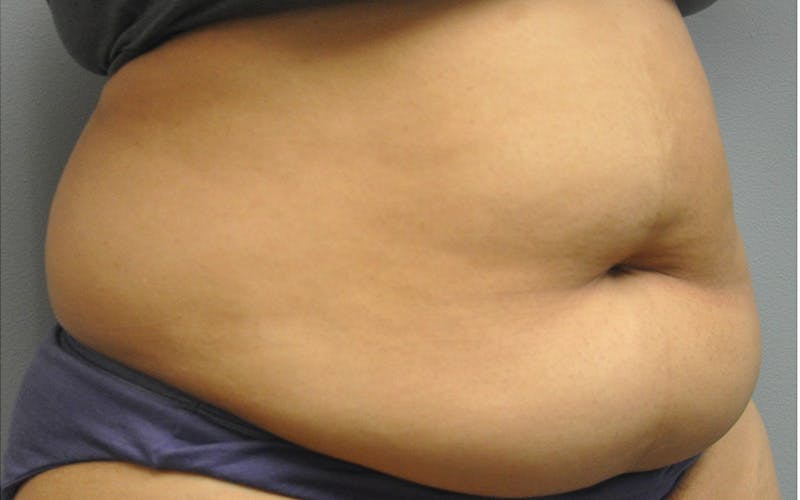 Tummy Tuck Before & After Gallery - Patient 158773 - Image 3