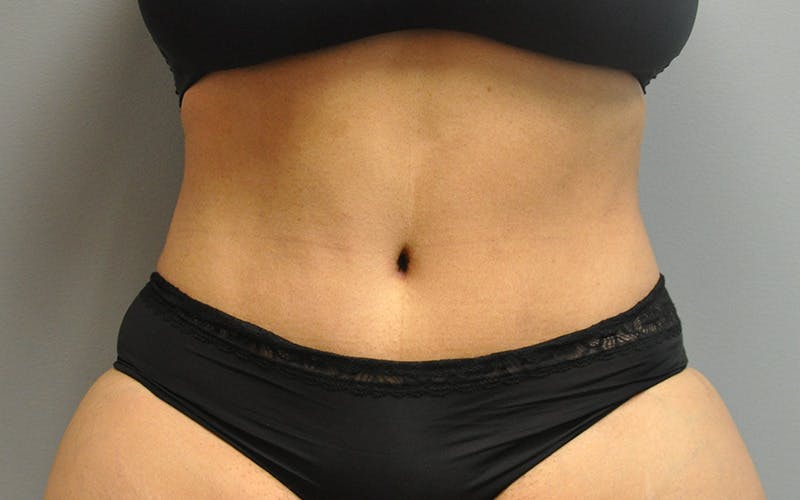 Tummy Tuck Before & After Gallery - Patient 158773 - Image 2