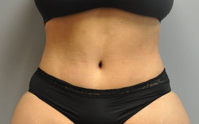 Tummy Tuck Before & After Gallery - Patient 158773 - Image 2